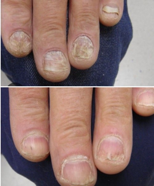 Ilustrativa: uñas de las manos afectadas y renovadas.