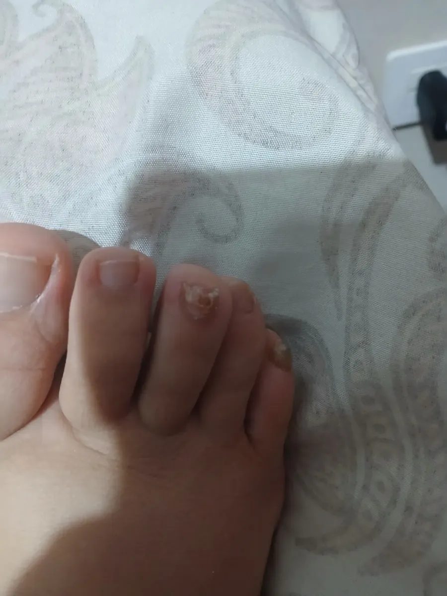Así empieza: una o dos uñas, sin dolor, y el reflejo de esconderlas.